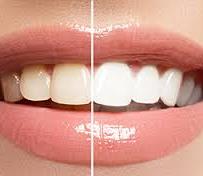 Comparison of teeth
